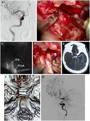 Case Report: Internal Carotid Artery Thrombosis: A Rare Complication After Fibrin Glue Injection for Cavernous Sinus Hemostasis